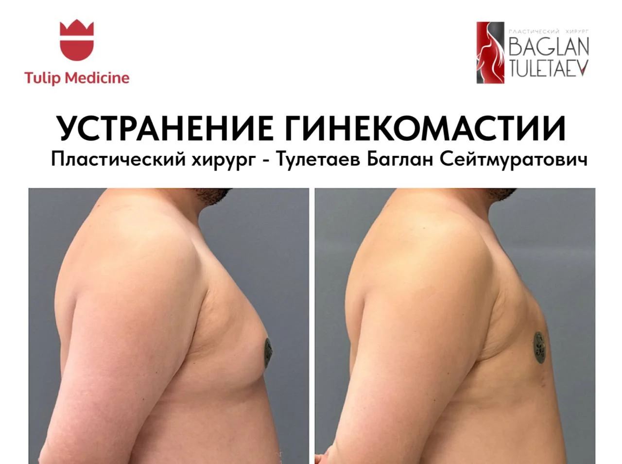 Удаление гинекомастии в Астане у пластического хирурга Баглана Тулетаева. Цена от 600 000 ₸, фото результата и этапы операции.