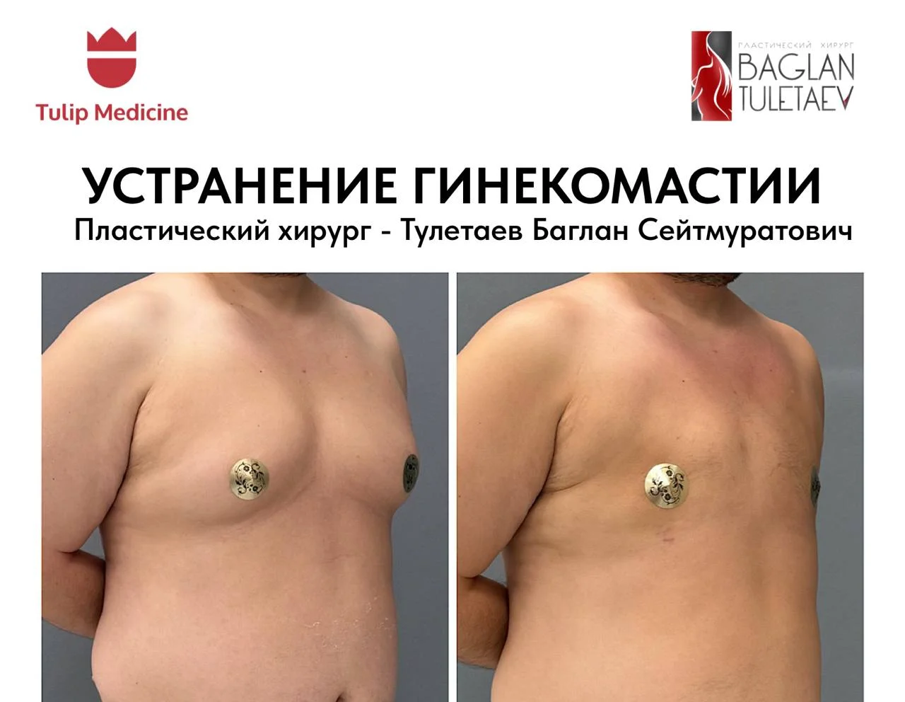 Гинекомастия у мужчин: операция в Астане, цена, диагностика и восстановление. Реальный результат Tulip Medicine через два месяца.