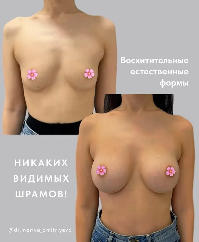 Увеличение груди без компромиссов: Motiva и Polytech, подбор формы и объёма, консультация хирурга в Tulip Medicine.