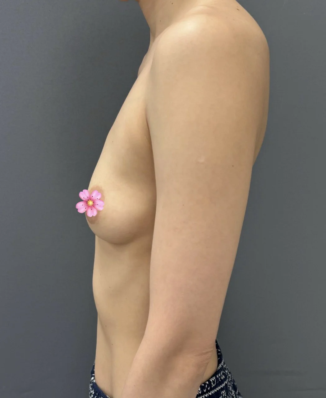 Грудь липофилинг в Астане: собственный жир вместо имплантов, современные протоколы безопасности, данные исследований и опыт хирурга.