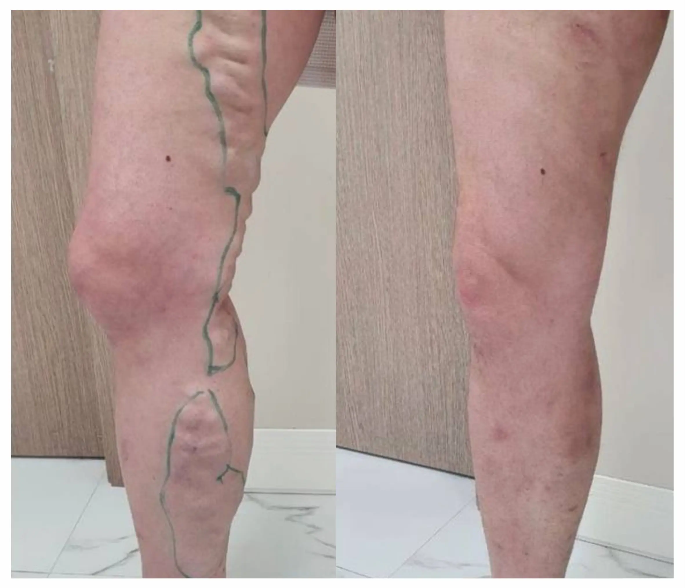 Ищете флеболога в Алматы? В Tulip Medicine доступны консультация, УЗИ вен нижних конечностей, ЭВЛК, склеротерапия и лазерное лечение сосудов.