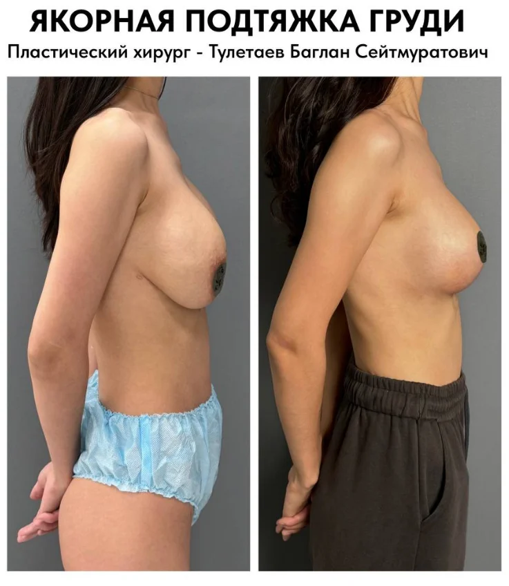 Якорная подтяжка груди в Астане: реальные фото, цена процедуры и подробности операции от лучших хирургов Казахстана.