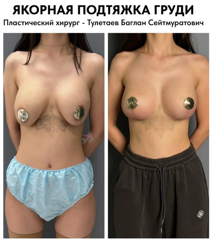 Цена якорной подтяжки груди в Астане с фото и описанием результатов. Профессионализм, безопасность и естественный эффект.