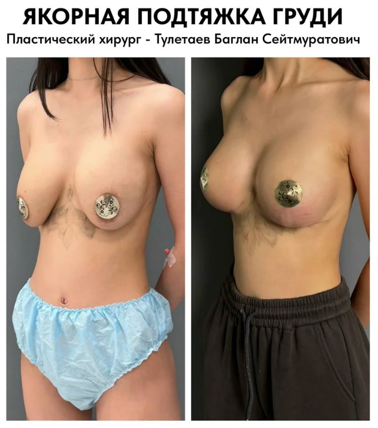 Якорная подтяжка груди в Астане: реальные фото, цена процедуры и подробности операции от лучших хирургов Казахстана.